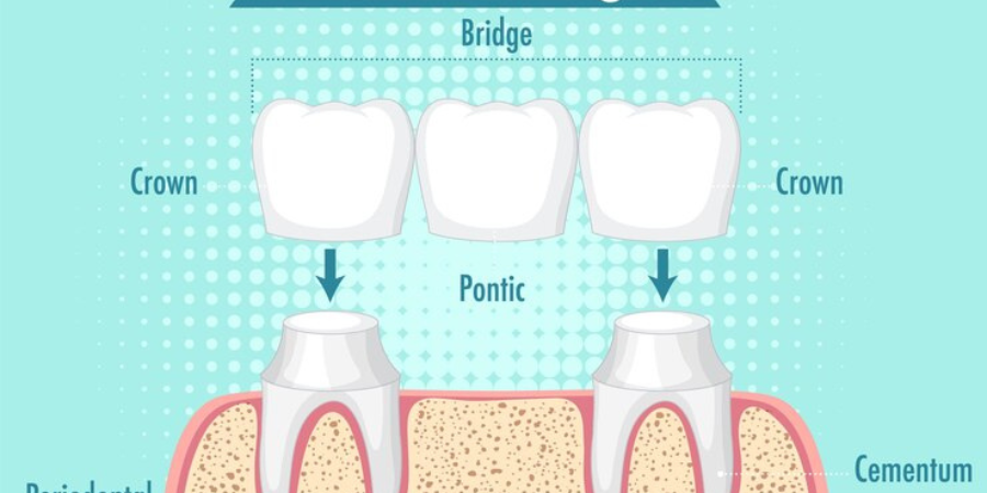 Dental bridges