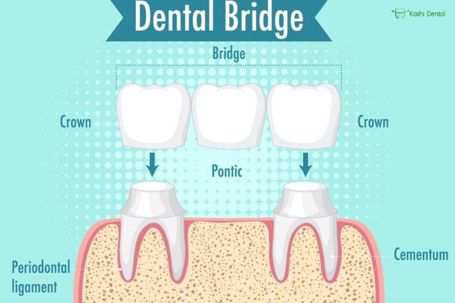 Dental bridges