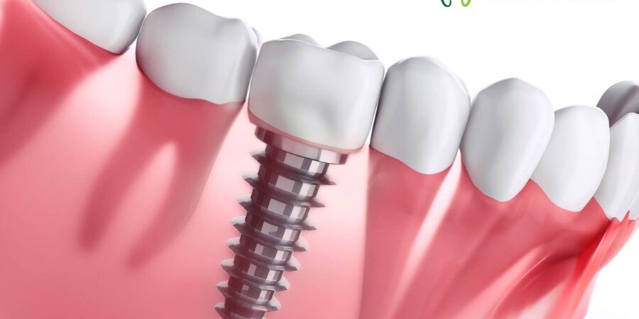 Dental implants