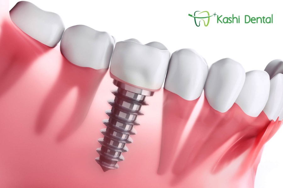 Dental implants