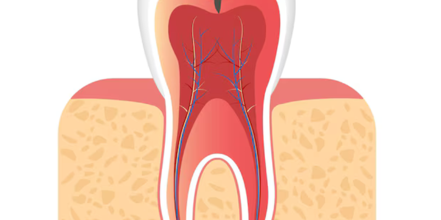 Root Canal