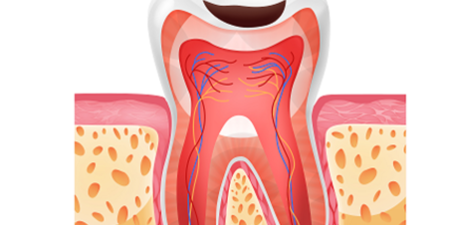 root canal