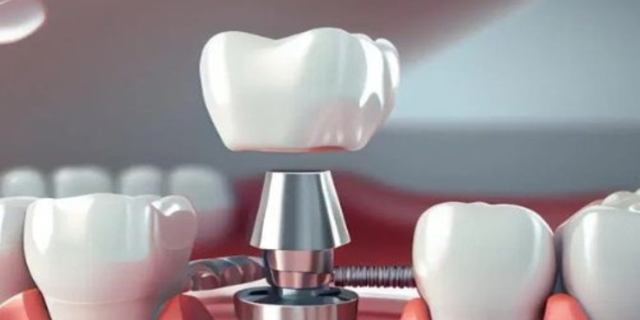 Dental implants