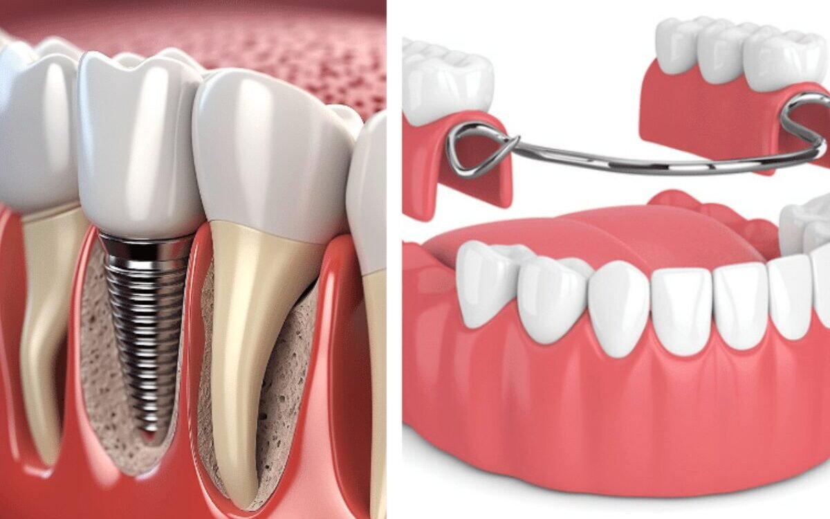 Dental Implants vs. Dentures
