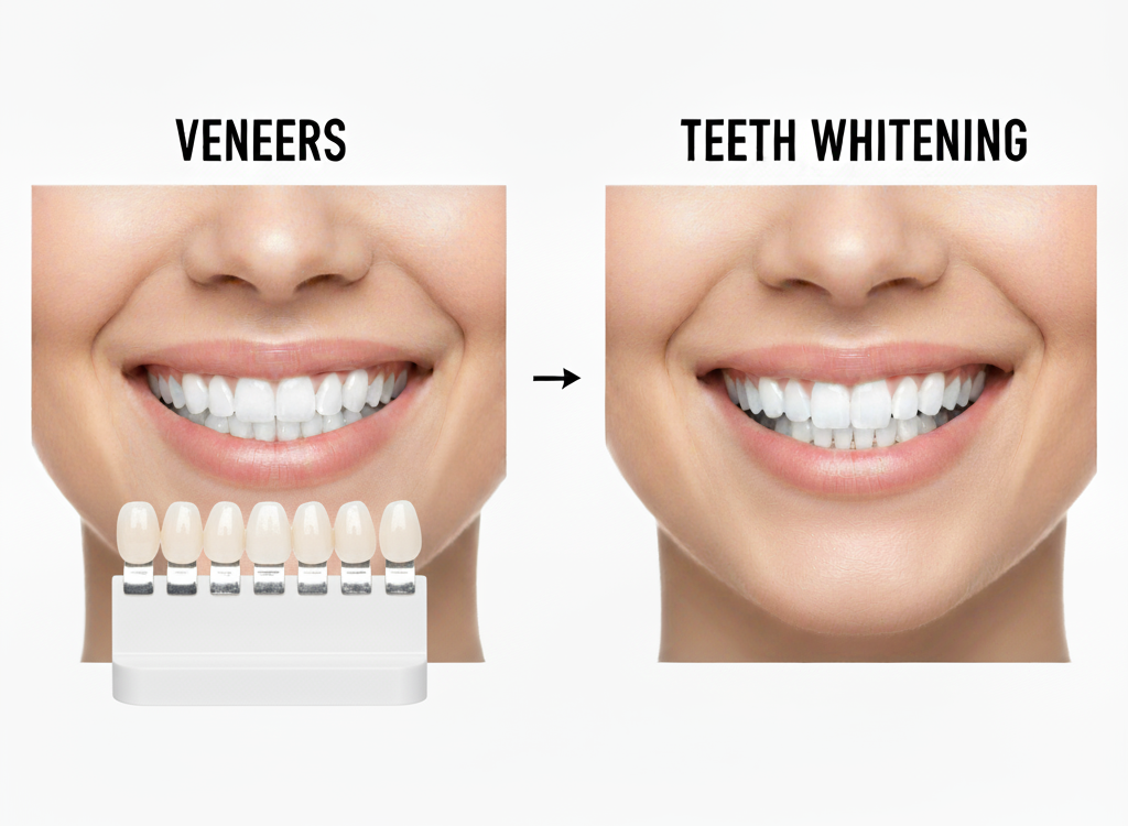 Close-up of veneers on teeth for a smile makeover
